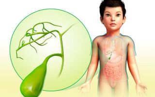 Симптомы и лечение перегиба желчного пузыря у детей