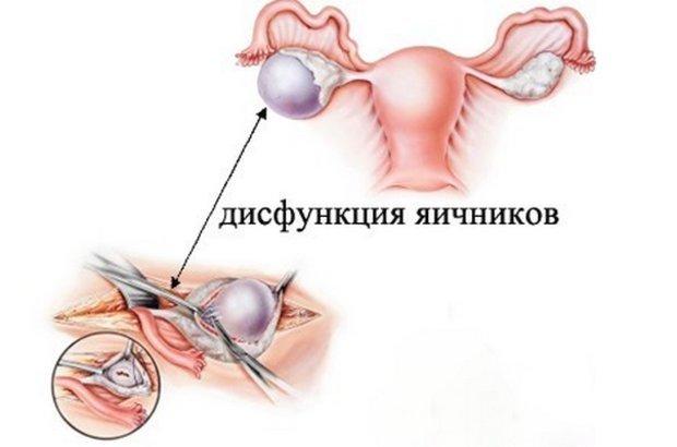 Схема дисфункции яичников
